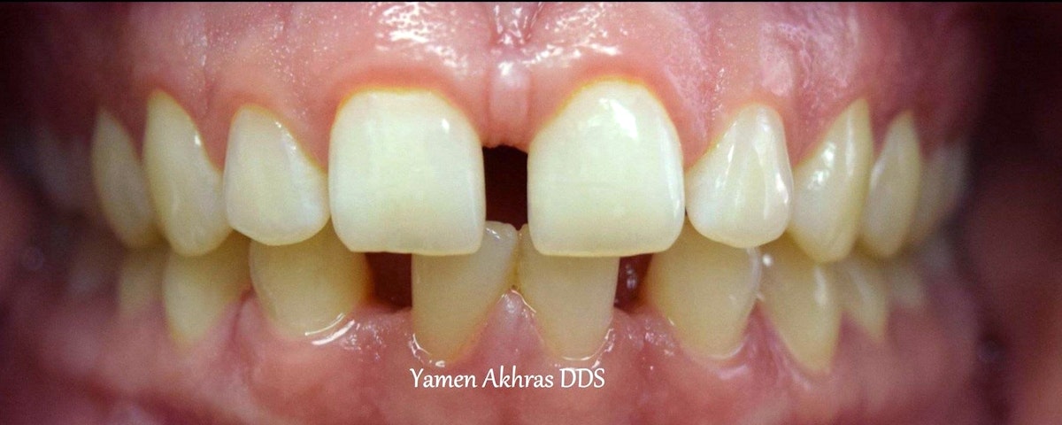 Gapped smile with crooked teeth