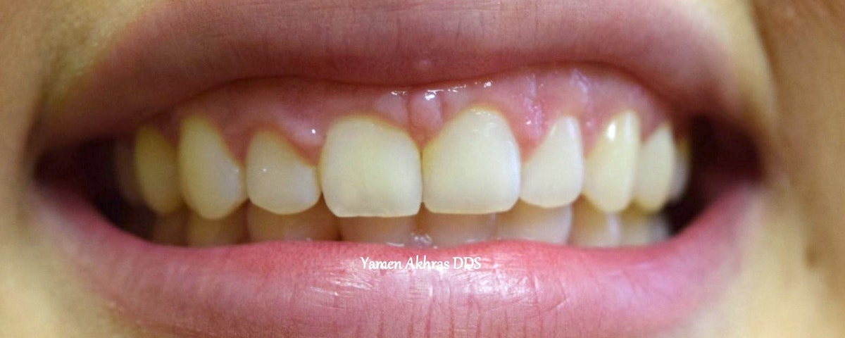 A straight seamless smile following braces and dental bonding