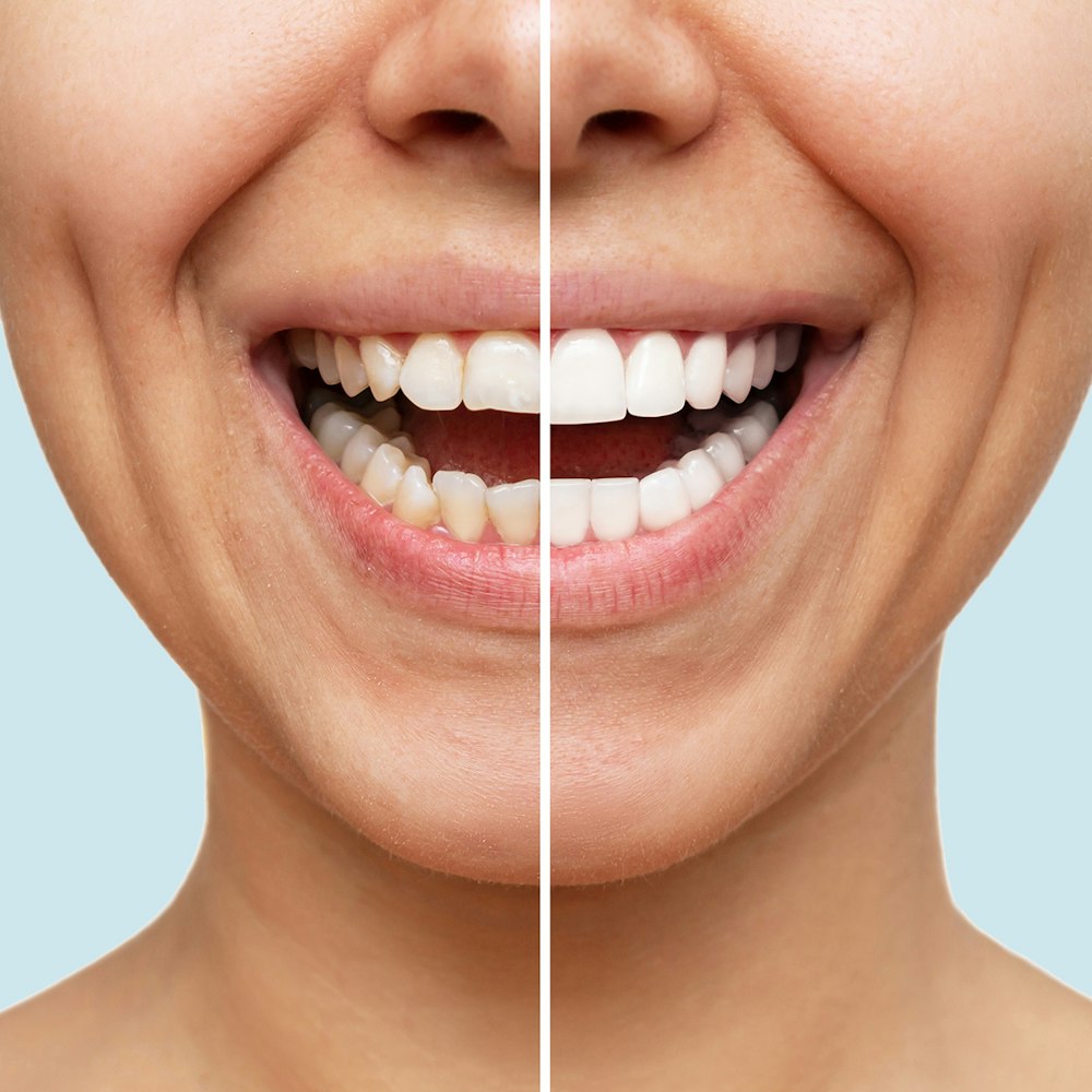 Before and after veneers