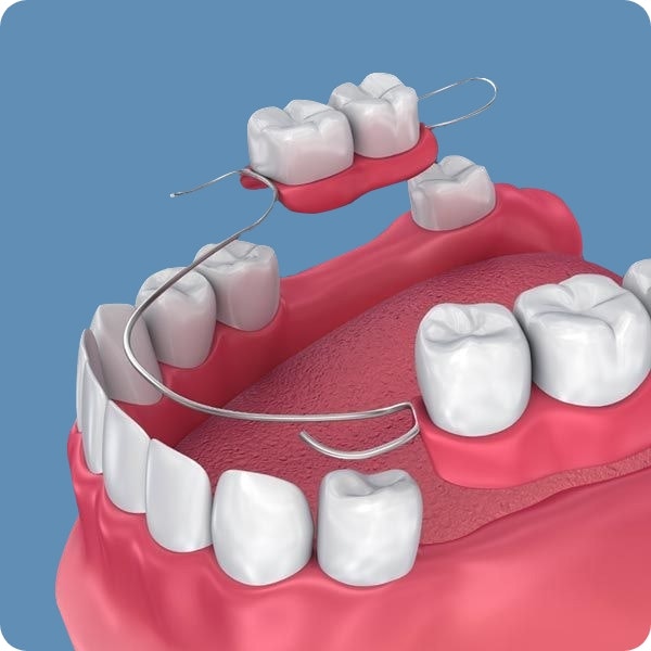 Partial Dentures