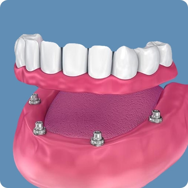 Implant-Supported Dentures