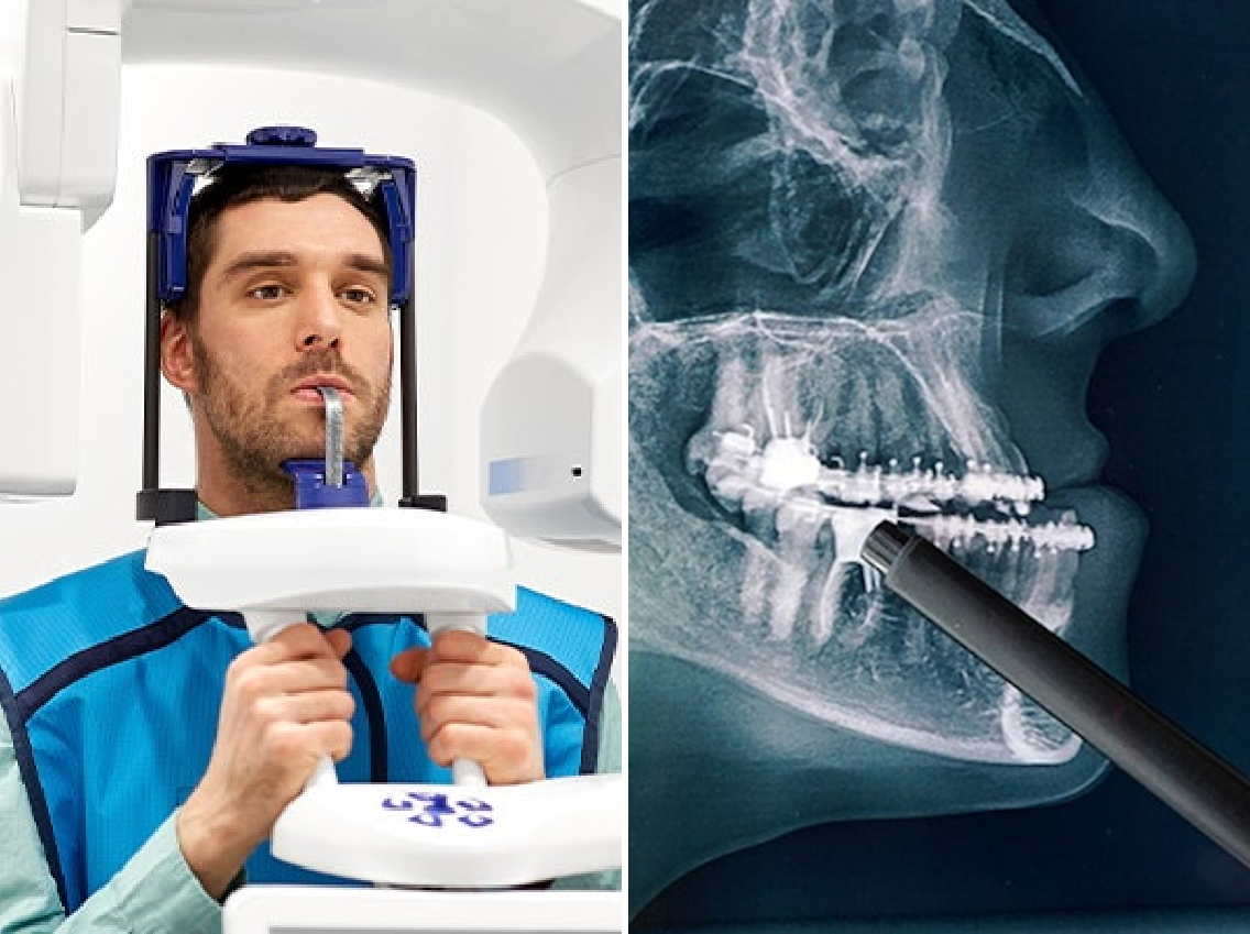 Pen pointing to tooth on dental x-ray and cone beam scanner