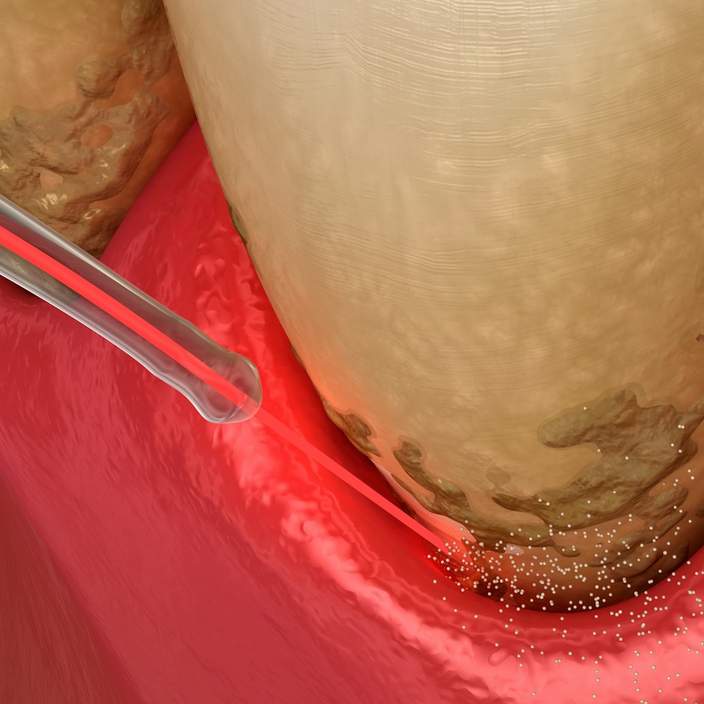 A render of laser dentistry