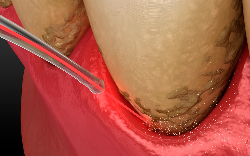 A render of laser dentistry