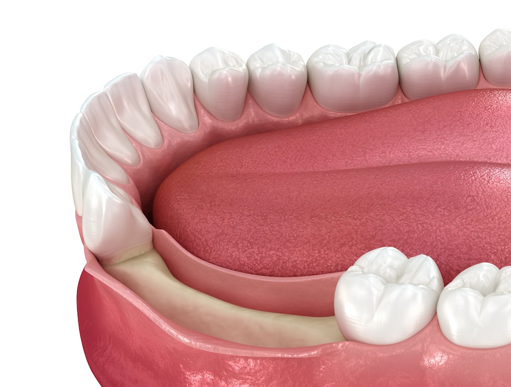 A render of Perio GTR treatment