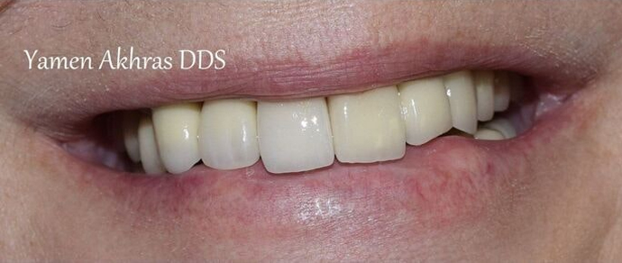 Patient 3 after dental implants