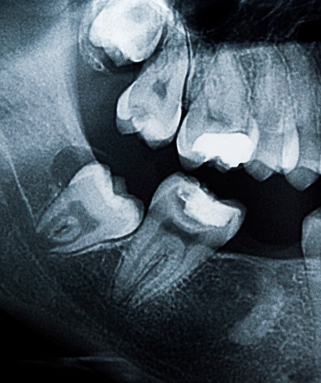 Dental x-ray