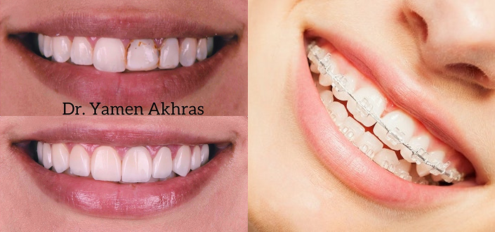 patient before and after orthodontics and braces collage