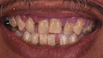 before denture implants