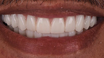after denture implants