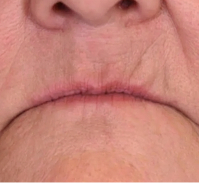 mouth before dentures