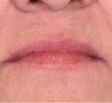 mouth after dentures