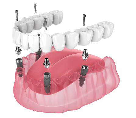 all-on-4 implant model