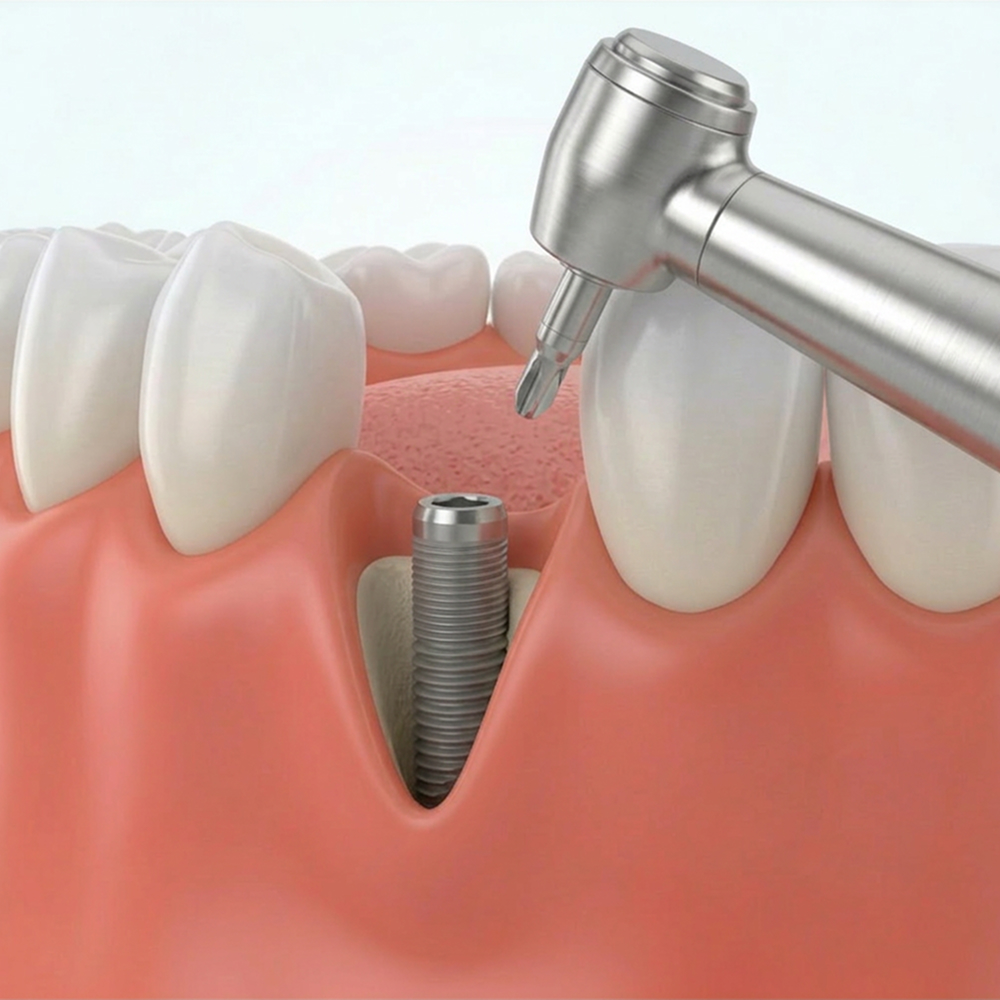 Dental implants