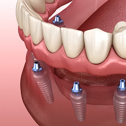 an implant denture being placed