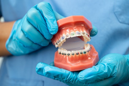 hands holding a dental model with braces