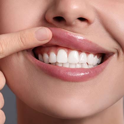 Woman lifting lip to show signs of gum disease