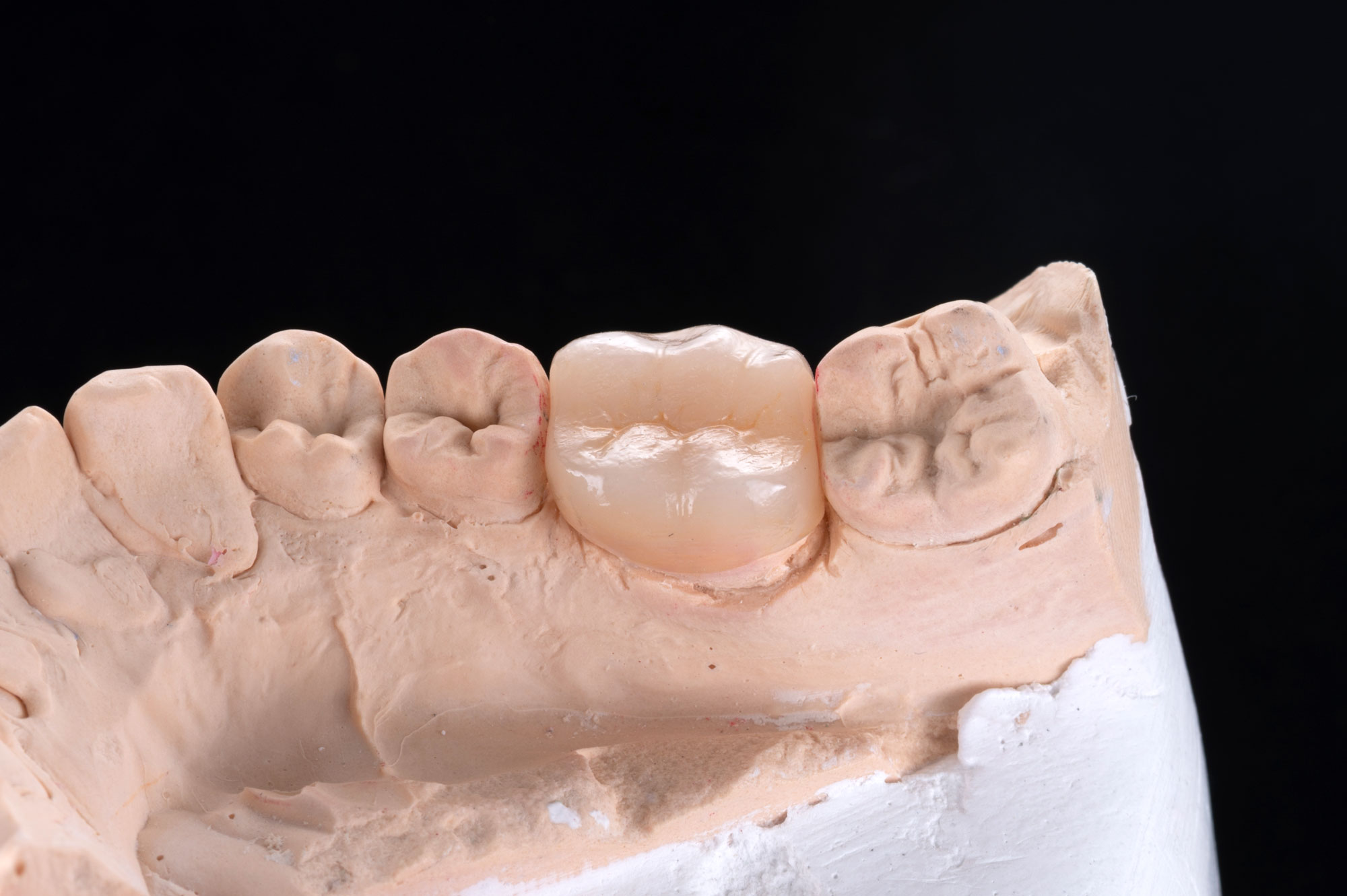 dental crown in a model dental arch