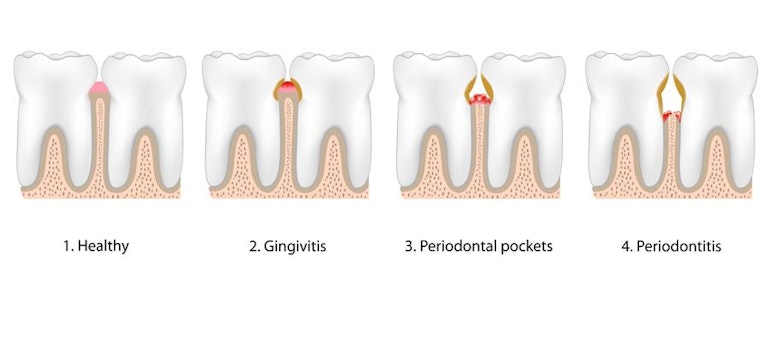 illustration of stages of gum disease
