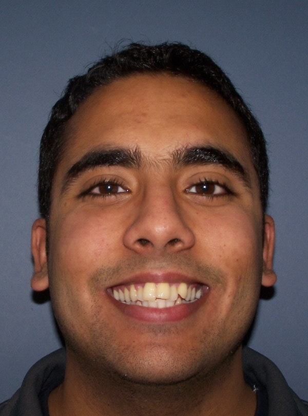 Kellyn Hodges Orthodontics patient before orthodontics