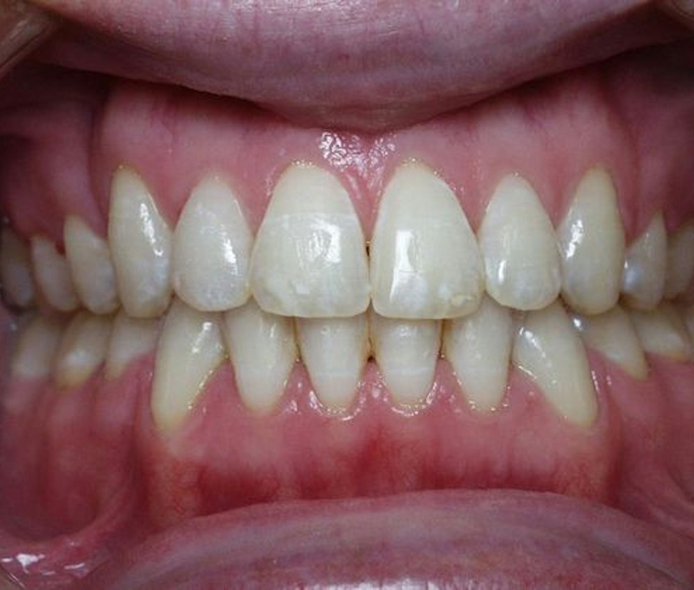 after traditional braces