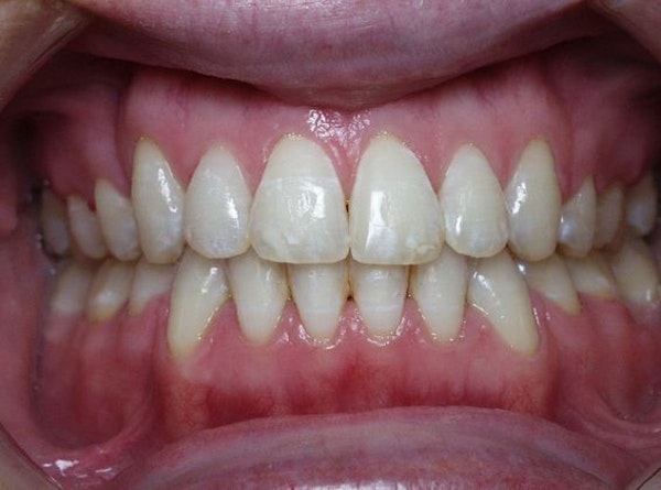 Kellyn Hodges Orthodontics patient after image of straightened and whitened smile