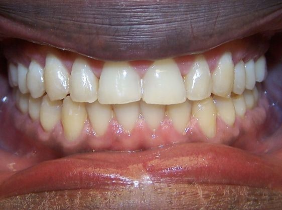 Kellyn Hodges Orthodontics patient after Invisalign