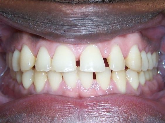 Kellyn Hodges Orthodontics patient before Invisalign