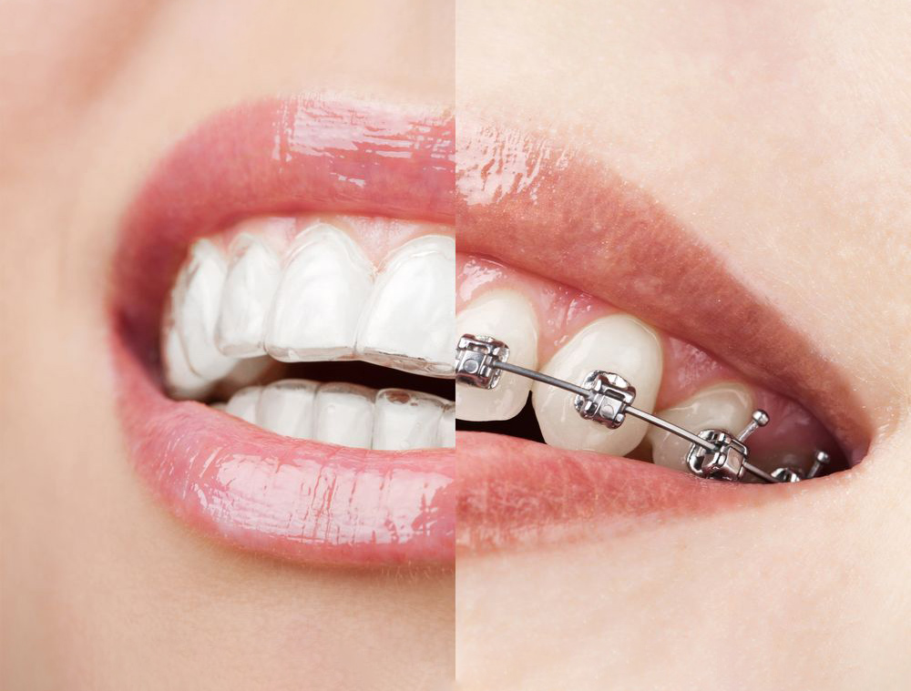 Braces Philadelphia, PA - Bala Cynwyd, PA - Bensalem, PA - Metal Braces -  Kellyn Hodges Orthodontics