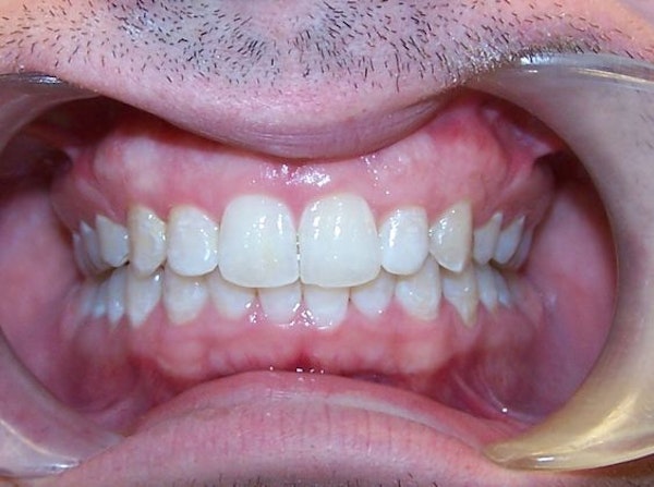 After Invisalign, closed gap