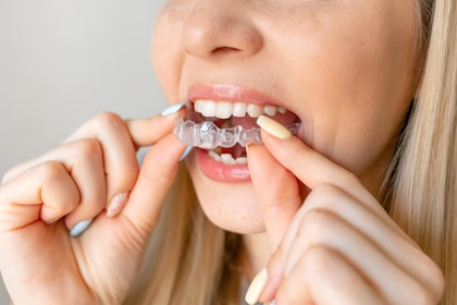 girl placing her retainer