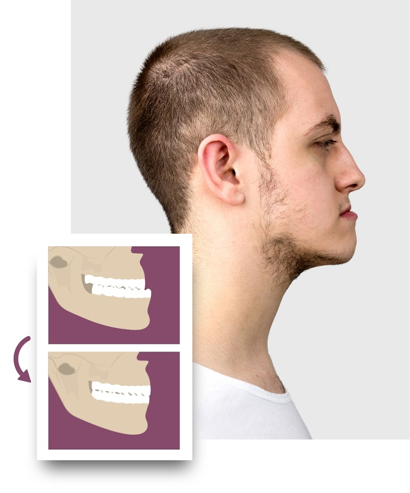 side view of a model with an underbite