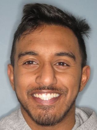  patient after Invisalign