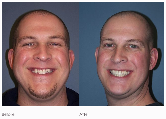 a Philadelphia patient's before and after images from Kellyn Hodges Orthodontics