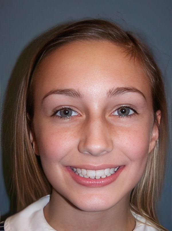After orthodontics