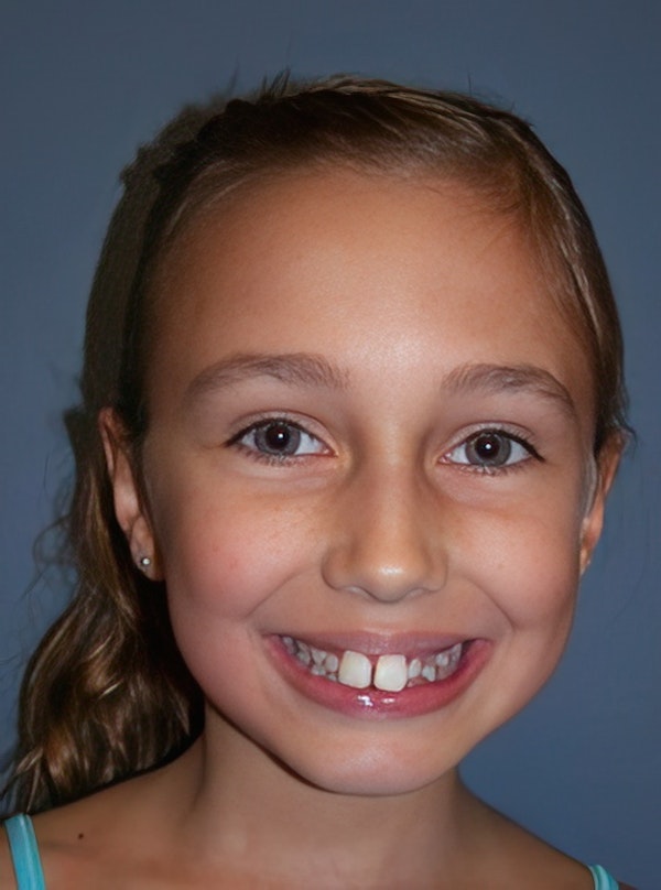 Before orthodontics