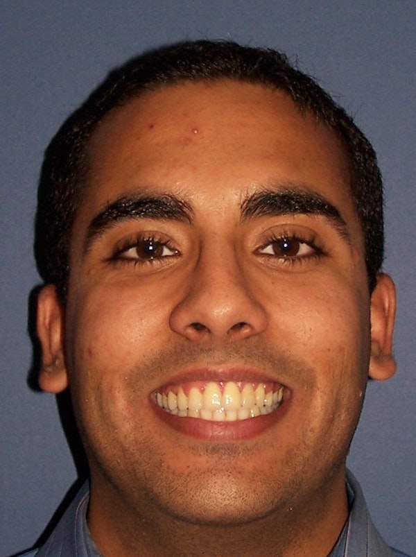 Kellyn Hodges Orthodontics patient after orthodontics