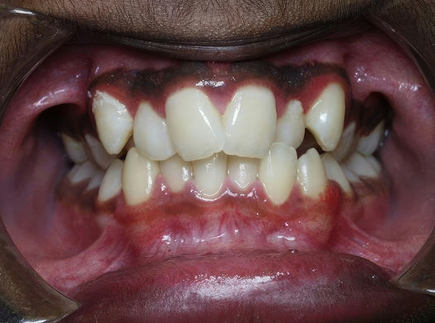 Kellyn Hodges Orthodontics's Patient Before Orthodontics