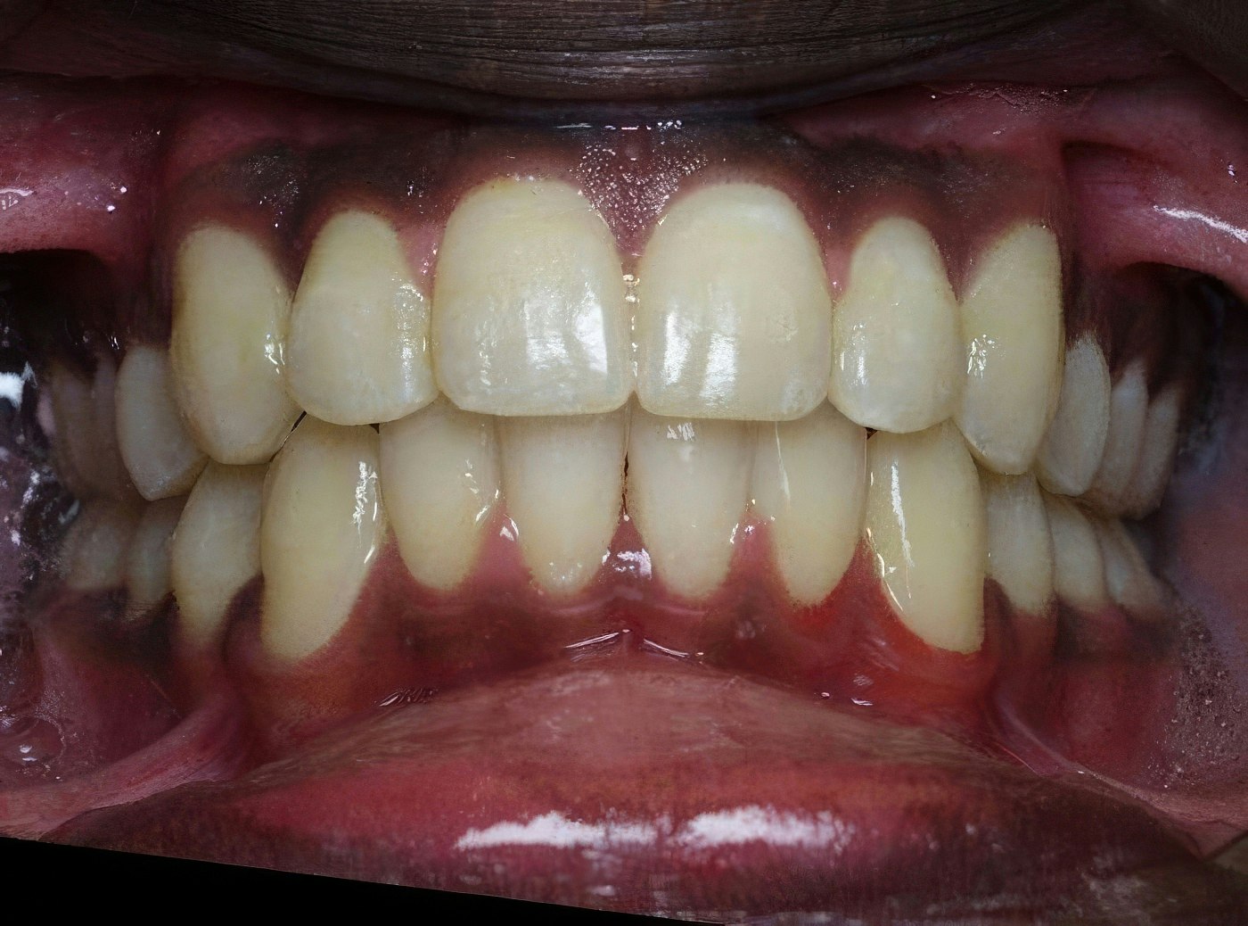 Kellyn Hodges Orthodontics's Patient After Orthodontics