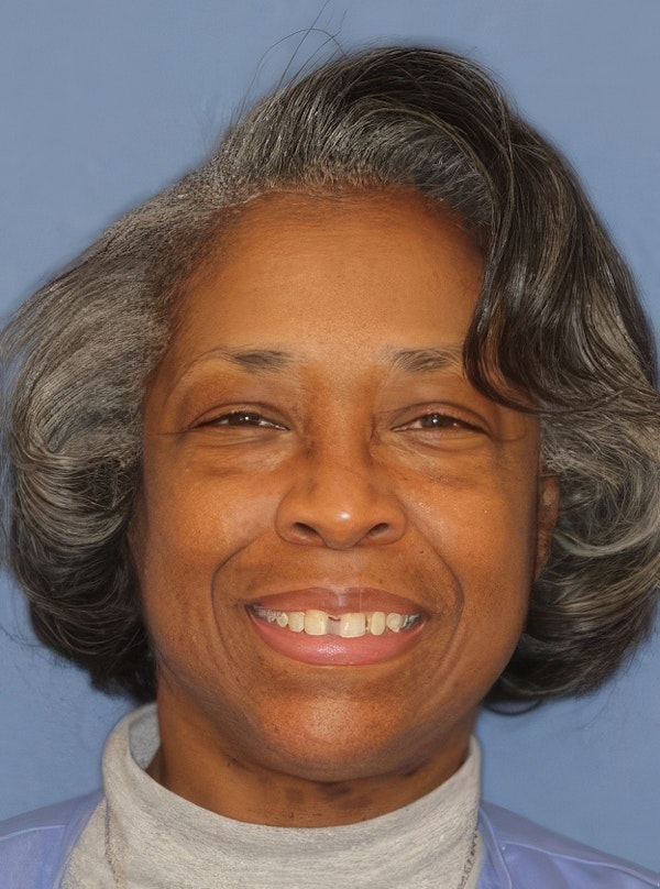 Kellyn Hodges Orthodontics patient before treatment