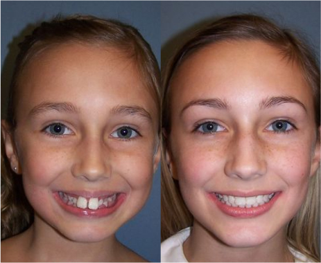 Dr. Hodges patient before and after orthodontics