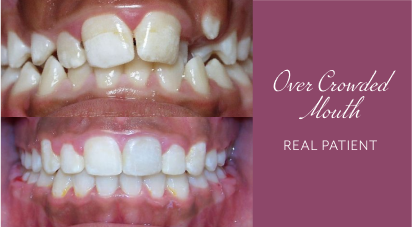 Dr. Hodges patient before and after orthodontics