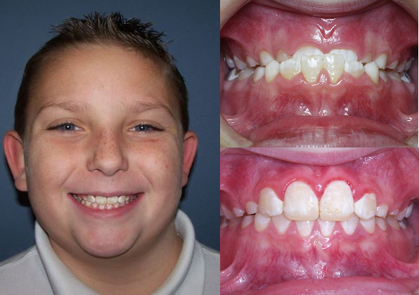 Dr. Hodges patient before and after orthodontics