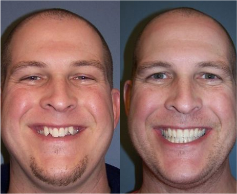 Real patient before and after braces