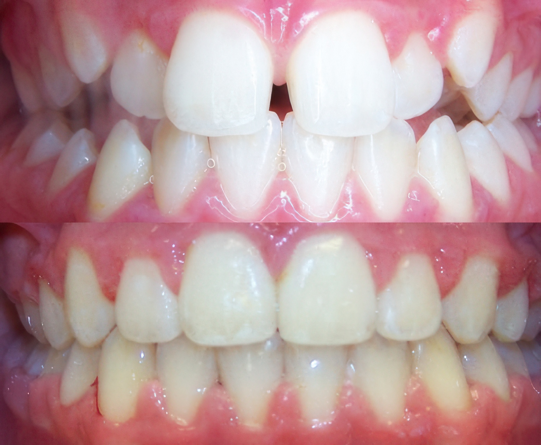 orthodontics before and after