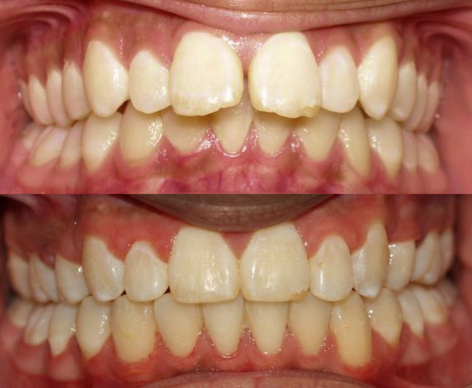 patient smile before and after orthodontics
