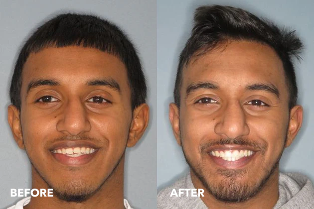 Montgomeryville patient before and after Invisalign treatment