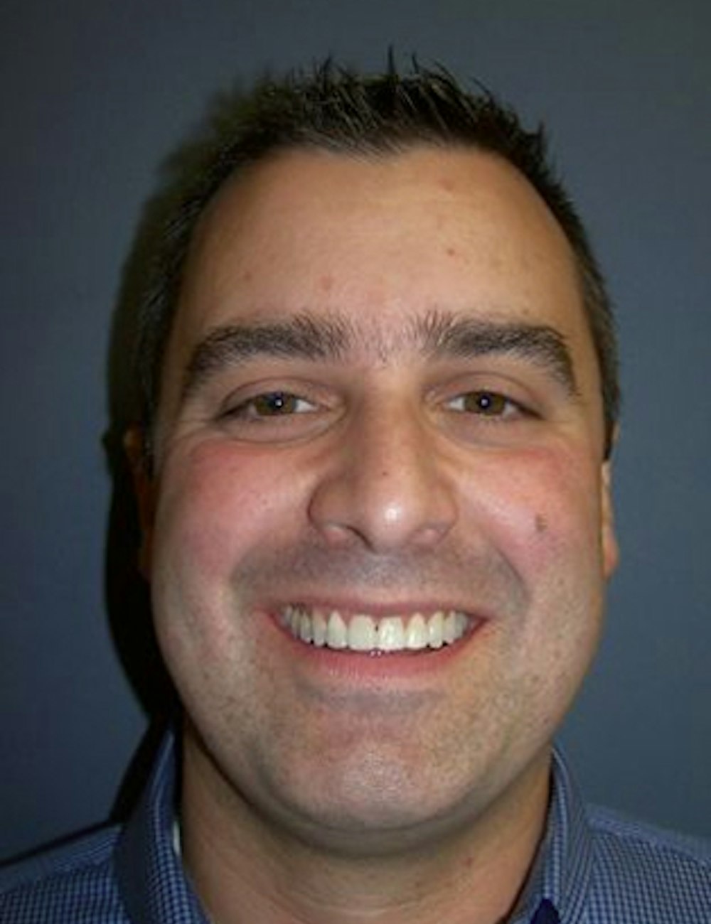 patient after Invisalign