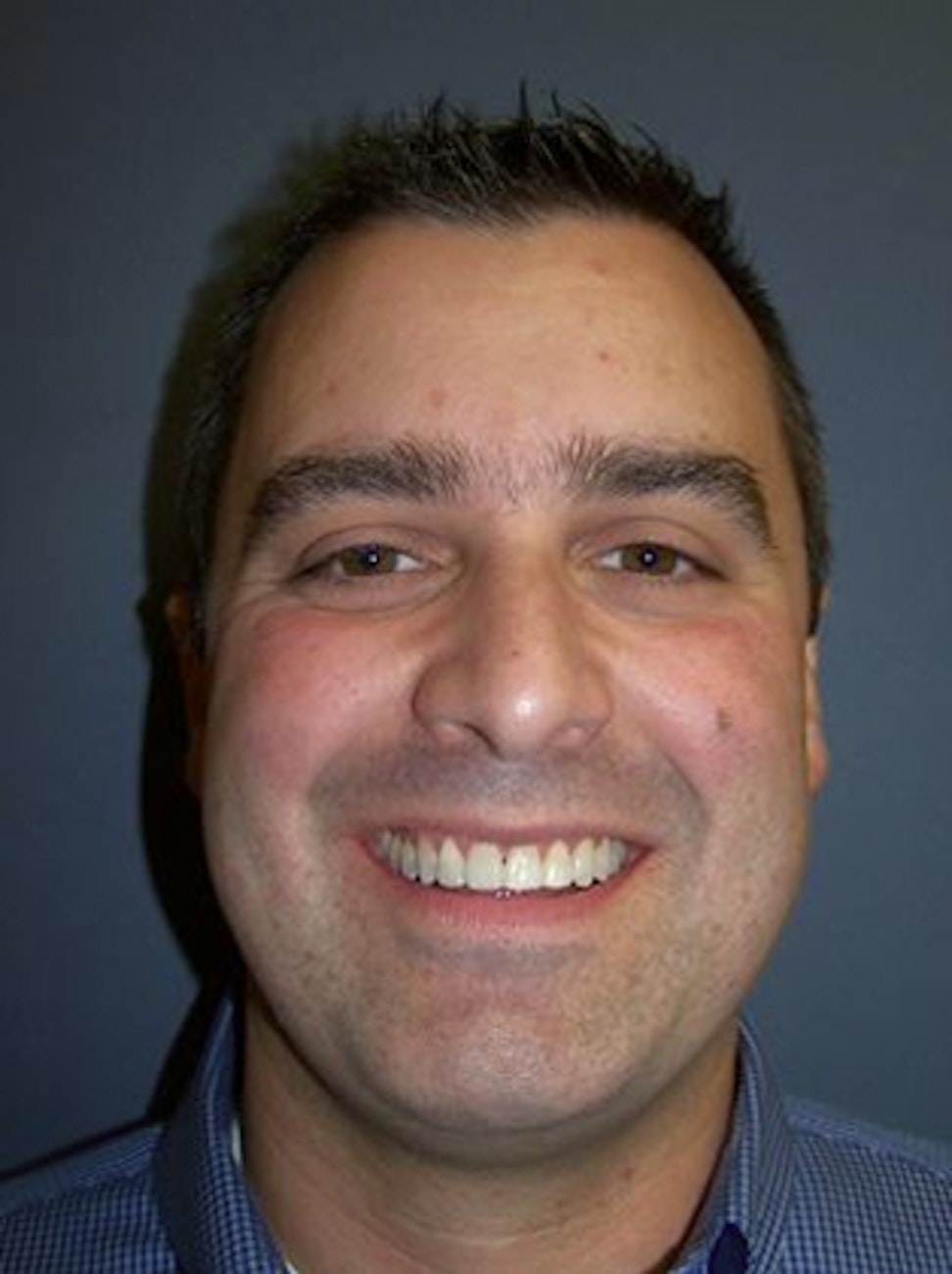 patient after Invisalign