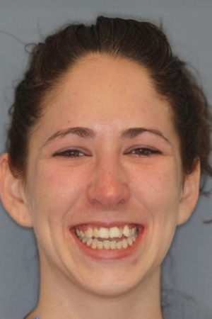 before orthodontics